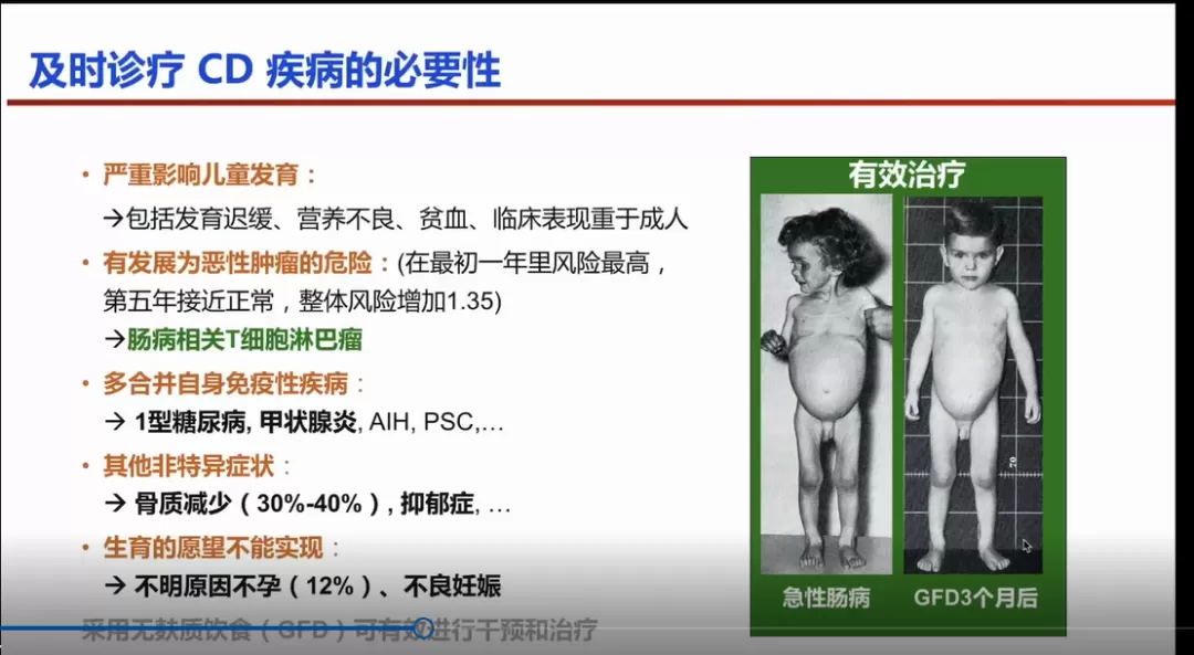 不止是腹泻？面对乳糜泻“冰山样”症状的分布，这份应对攻略请收好