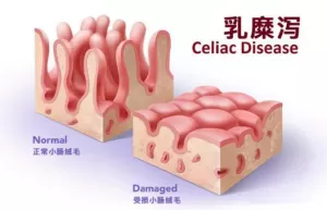 乳糜泻≠麸质过敏，那些由麸质引发疾病的区别和联系